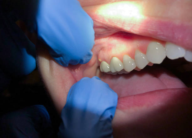 Best Emergency Denture Repair in Kansas City, MO