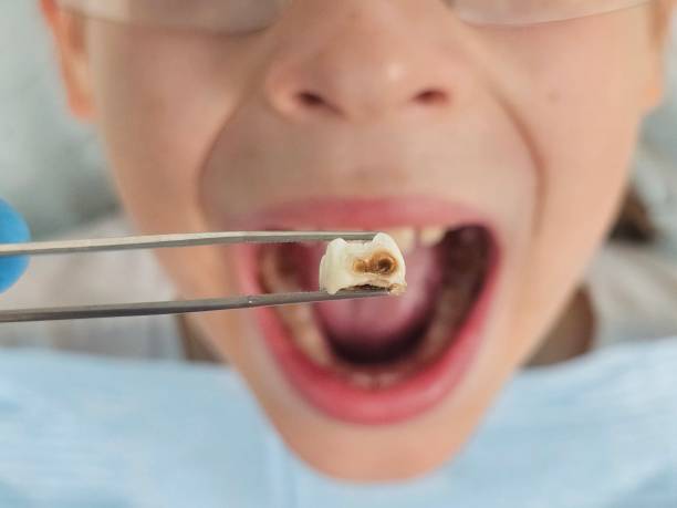 Best Emergency Gum Treatment in Kansas City, MO
